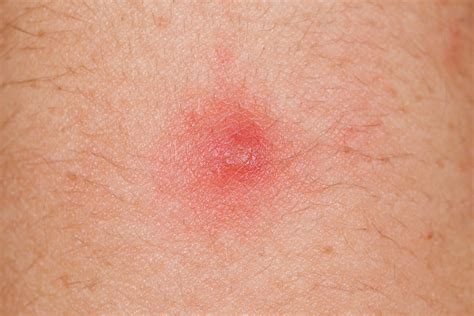 Boils can occur outside of the vagina on the labia, vulva or pubic area. . Hard lump after boil drained reddit